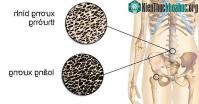 Ảnh Top 4 loại thực phẩm là “Vua ăn cắp canxi”, khiến nhiều người chỉ ngã nhẹ cũng gãy xương