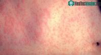 Ảnh Những loại bệnh lây truyền qua đường không khí