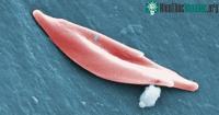 Ảnh Anh phê duyệt loại thuốc chỉnh sửa gene đầu tiên trên thế giới