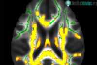 Ảnh Mỡ bụng cảnh báo căn bệnh Alzheimer?