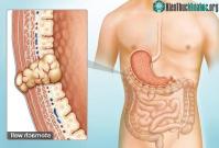 Ảnh Bệnh u mô đệm đường tiêu hóa là bệnh gì? Có nguy hiểm không?