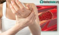 Ảnh Những điều nên và không nên làm khi bạn phát hiện có cục máu đông