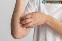 Ảnh Dấu hiệu cảnh báo bị nhiễm ký sinh trùng
