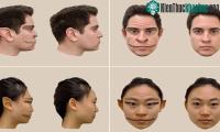 Ảnh Hội chứng cực hiếm khiến cho con người trông thấy "mặt quỷ"