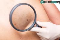 Ảnh Công nghệ mới trên điện thoại 6G có thể giúp phát hiện sớm bệnh ung thư da