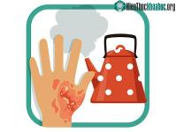 Ảnh Hướng dẫn cách sơ cấp cứu người bị bỏng nhiệt hiệu quả