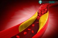 Ảnh Lý do mà người trẻ cũng bị máu nhiễm mỡ