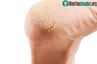 Ảnh Soi bàn chân mà thấy dấu hiệu này, phải cẩn thận kẻo gan suy hỏng, mất chức năng từ bao giờ