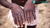 Ảnh Giới nghiên cứu lo ngại: Virus gây bệnh đậu mùa khỉ biến đổi nhanh hơn bình thường