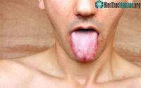Ảnh Bệnh giang mai là thế nào?