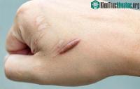 Ảnh Tại sao ăn rau muống lại gây sẹo lồi?