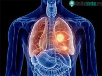 Ảnh Tìm thấy lý do khiến ngày càng nhiều người trẻ bị ung thư