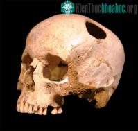 Ảnh Các cách phẫu thuật "cắt ghép cơ thể" từ ghê rợn đến hiện đại