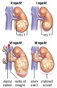Ảnh Hy vọng cho việc chữa trị ung thư thận