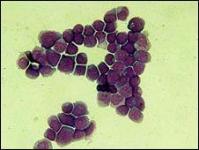 Ảnh Tìm ra bản đồ gene của bệnh ung thư