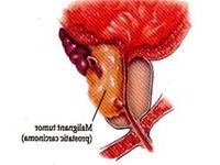 Ảnh Phát hiện bộ gene độc đáo gây ung thư tiền liệt tuyến