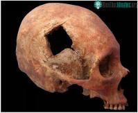 Ảnh Phẫu thuật não của người Inca thuộc dạng “trình độ cao”