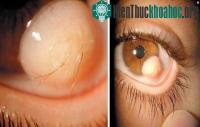 Ảnh Mọc lông trong nhãn cầu