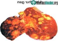 Ảnh Xét nghiệm mới giúp chẩn đoán sớm ung thư gan