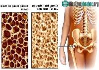 Ảnh Loãng xương: 35 tuổi trở lên, phải đề phòng