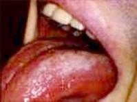 Ảnh Nhiễm nấm Panicillium marneffei: Một chỉ điểm AIDS