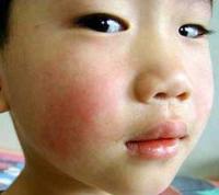Ảnh Mỹ: Bùng phát lây nhiễm bệnh quai bị