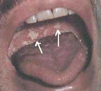 Ảnh Các tổn thương mô miệng ở trẻ em