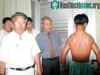 Ảnh Nguy hiểm khi chích vào cơ tứ đầu đùi và cơ Delta ở trẻ em