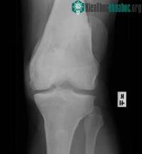 Ảnh Phát hiện bệnh viêm khớp bằng cách nghe đầu gối