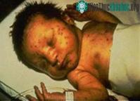 Ảnh Thai phụ nhiễm Rubella có nguy cơ sinh quái thai