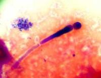 Ảnh Viêm nhiễm âm đạo do nấm candida
