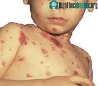 Ảnh Phòng bệnh thủy đậu trước mùa dịch