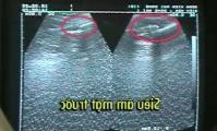 Ảnh Lần đầu tiên Việt Nam nắn xương bằng siêu âm