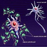Ảnh Trị bệnh Alzheimer bằng hạt vàng nano