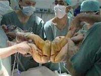 Ảnh Tách rời thành công hai bé trai có cột sống dính nhau