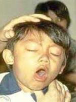 Ảnh Chứng ho lâu ngày ở trẻ