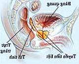 Ảnh Cắt bỏ tuyến tiền liệt dễ gây bất lực