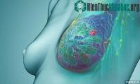 Ảnh Dấu hiệu ban đầu một số bệnh ung thư thường gặp