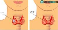 Ảnh Những thủ phạm gây bệnh ung thư vòm họng bạn nên tránh