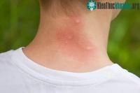 Ảnh Loài muỗi cũng biết sợ khi chúng ta làm công việc này