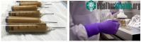 Ảnh Hiến tặng và cấy ghép chất thải từ người trong y học - tưởng đùa mà hóa thật 100%