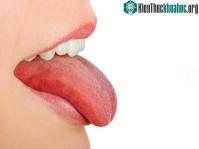Ảnh Đừng nhầm lẫn ung thư lưỡi với bệnh nhiệt miệng