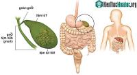 Ảnh Triệu chứng của ung thư đường mật khi đã di căn qua gan