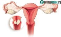 Ảnh 6 vấn đề cần quan tâm nhất của ung thư cổ tử cung mà bạn nữ nào cũng cần phải biết