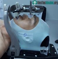 Ảnh Bệnh nhân bị ung thư chỉ cần 6 lần xạ trị nhờ kỹ thuật mới