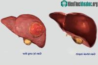 Ảnh Ung thư gan Việt Nam xếp thứ 4 thế giới, có thể điều trị u không cần phẫu thuật