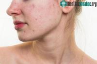 Ảnh Cách xử lý khi bị dị ứng với da mặt