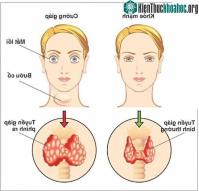 Ảnh 11 biến chứng suy tuyến giáp nguy hiểm khôn lường phải đặc biệt chú ý