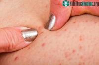 Ảnh Lưng mọc nhiều mụn có thể là dấu hiệu cảnh báo 4 vấn đề sức khỏe sau