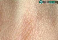 Ảnh Thử nghiệm cấy ghép da lợn biến đổi gene cho người?